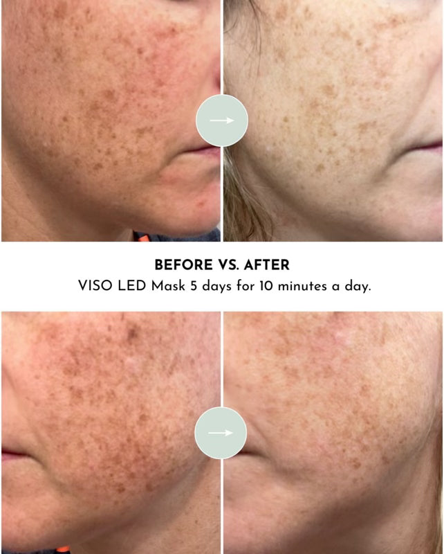 VISO Red Light Therapy Mask – FDA 510(k) Cleared | 470 Micro-LEDs | Full-Face 660nm Treatment